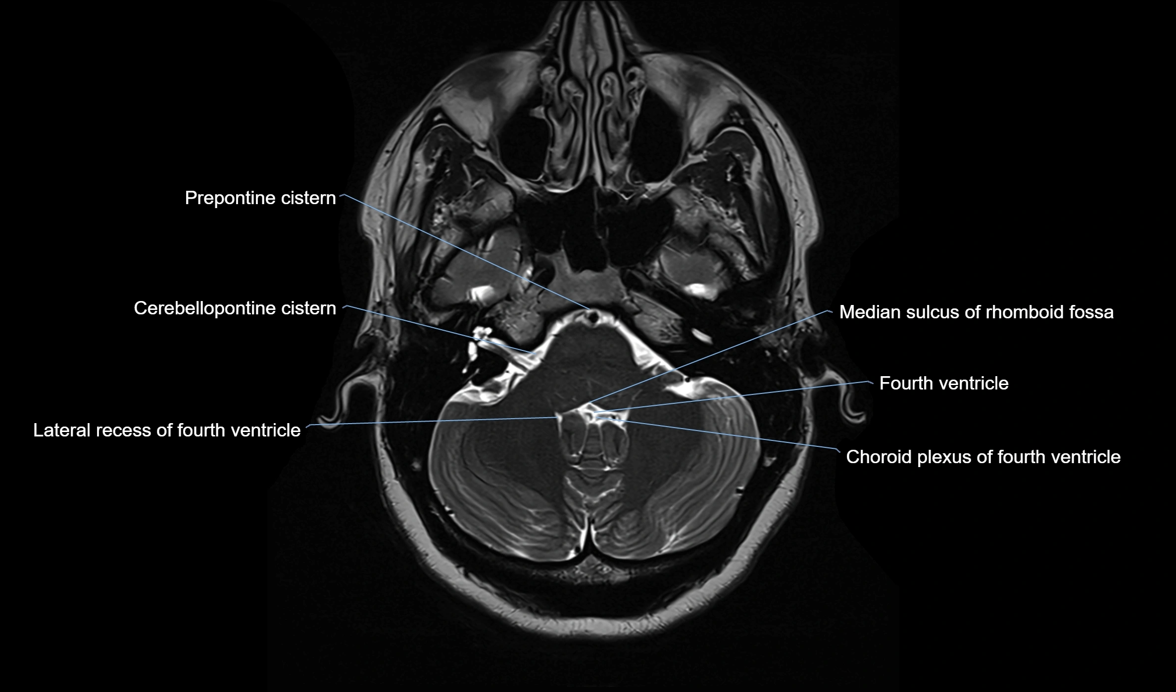 Brain cisterns  and ventricles  axial anatomy 3T MRI image-img-00001-00011.webp